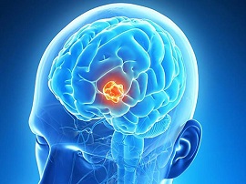 ۵ راه تشخیص و پیشگیری  سرطان مغز چیست؟