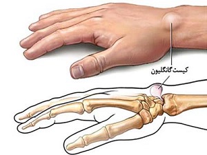 زائده ای به نام گانگلیون یا کیست سینوویال بر روی مچ دست 