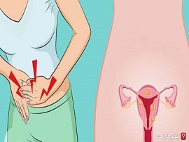 شایع‌ترین علت بروز سرطان دهانه رحم